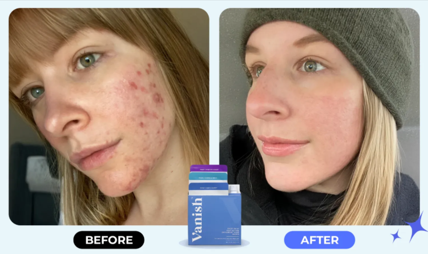 Vanish DrySerum Before After