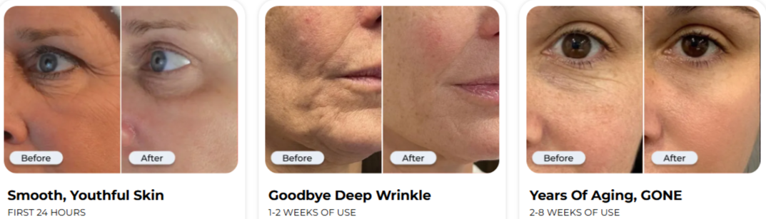 Glamory's MicroLift System Benefites